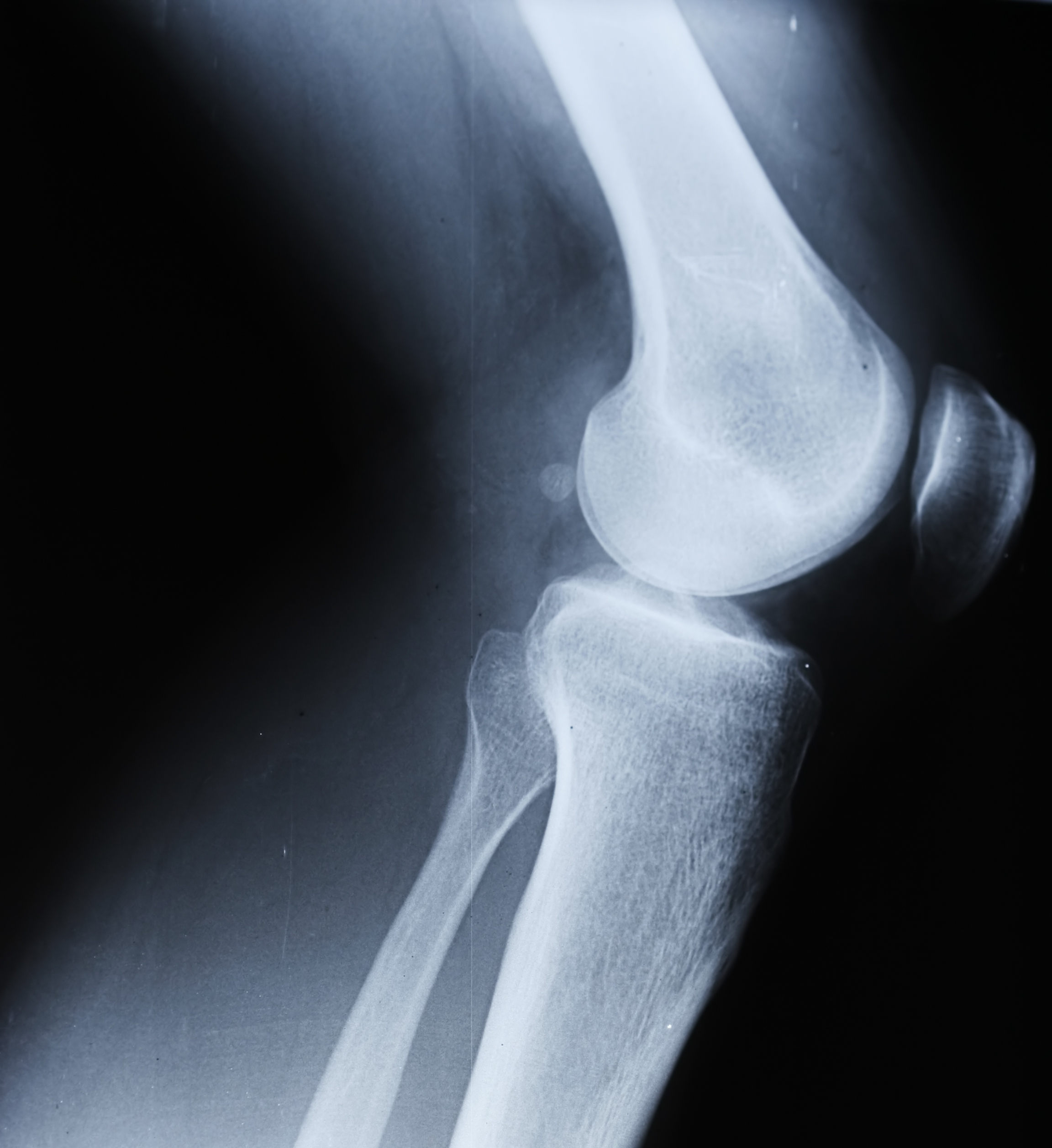 knee radiograph - Orthopaedic Surgeon Sunshine Coast Dr Steve Lawrie