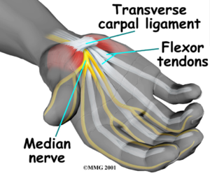 Carpal Tunnel 001 - Orthopaedic Surgeon Sunshine Coast Dr Steve Lawrie