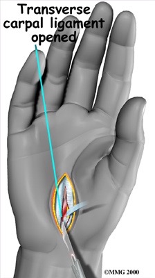 Carpal Tunnel Release - Orthopaedic Surgeon Sunshine Coast Dr Steve Lawrie